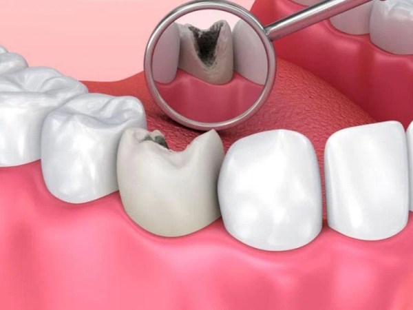 How to recognize tooth and molar&nbsp;cavities