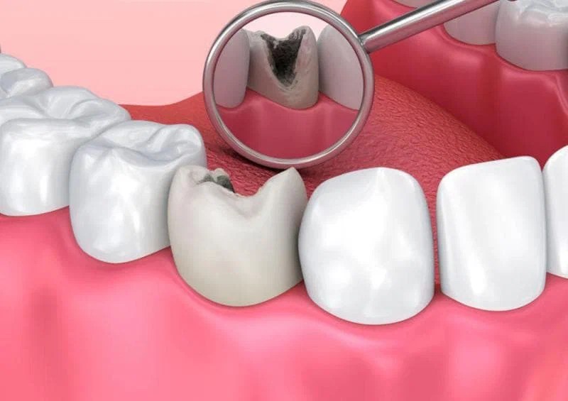 tooth decay cleaning